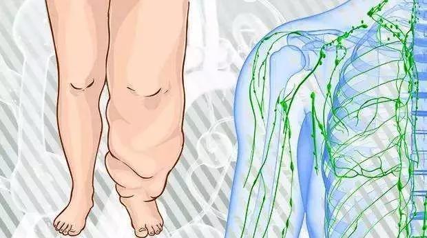 淋巴水肿最新疗法,淋巴水肿最新疗法研究与应用