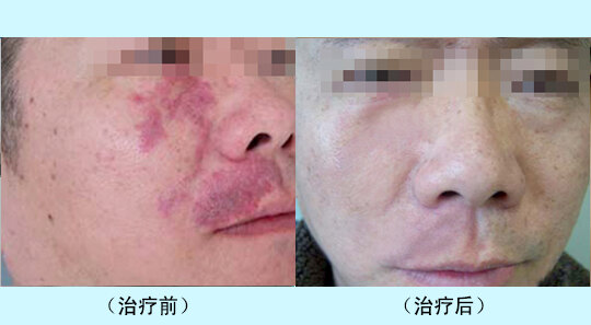 鲜红斑痣最新治疗方法,鲜红斑痣最新治疗方法，探索与突破，鲜红斑痣最新治疗方法的探索与突破，创新疗法揭秘